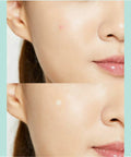 Buy acne treatment products in Singapore - COSRX Acne Pimple Master Patch